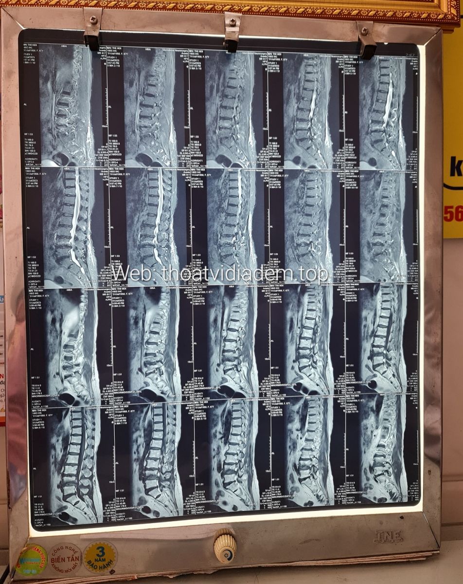 Hình ảnh thoát vị đĩa đệm L4 L5